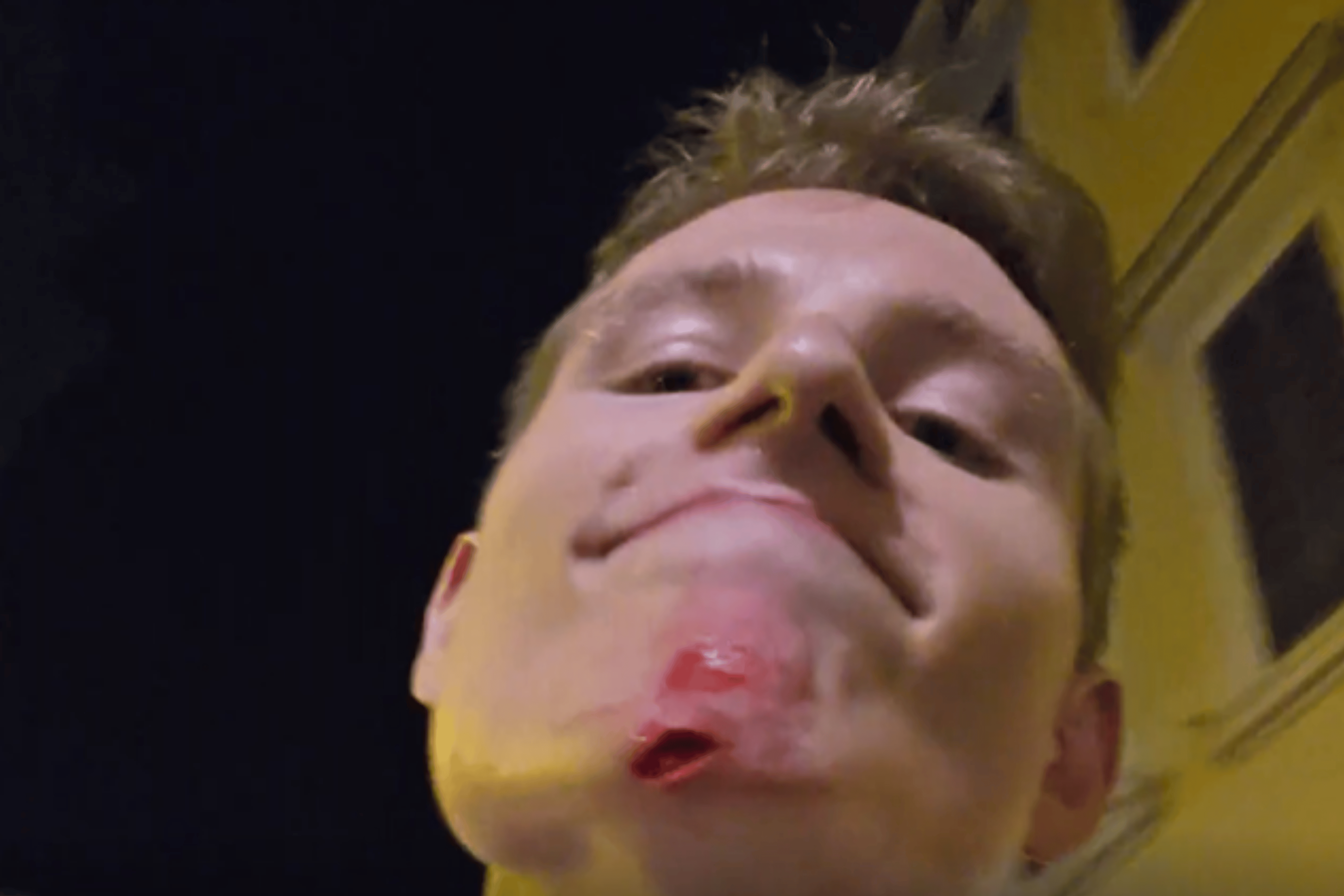 A man ran directly into Swedish streamer itsLander during an August 18, 2026 broadcast, leaving him with a bloody facial injury.